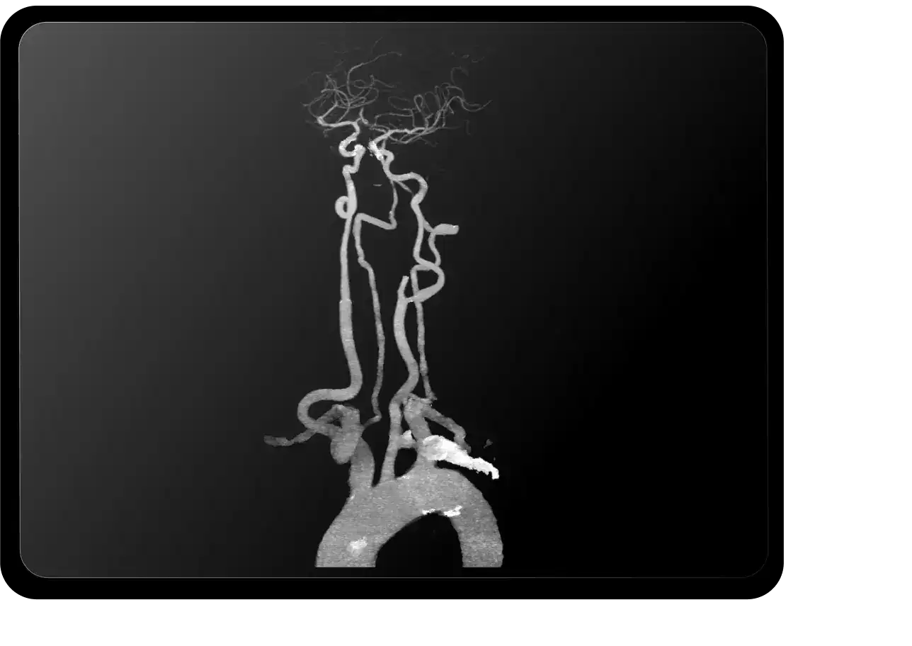 RapidAI: The AI That Reads Scans Before the Doctor Does