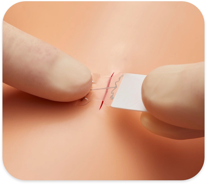 microMend Changes How Minor Wounds Are Closed