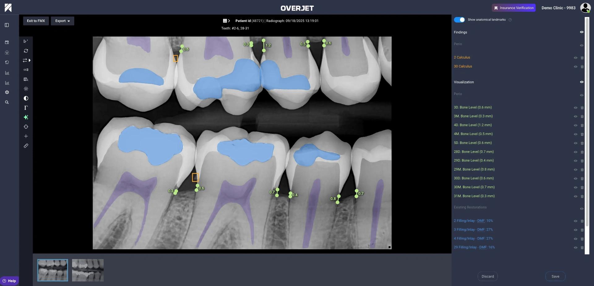 How Dental AI Is Catching What Dentists Miss 